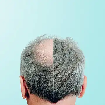 Afro Hair Transplant