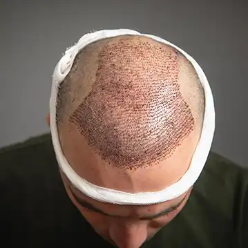 FUT Hair Transplant