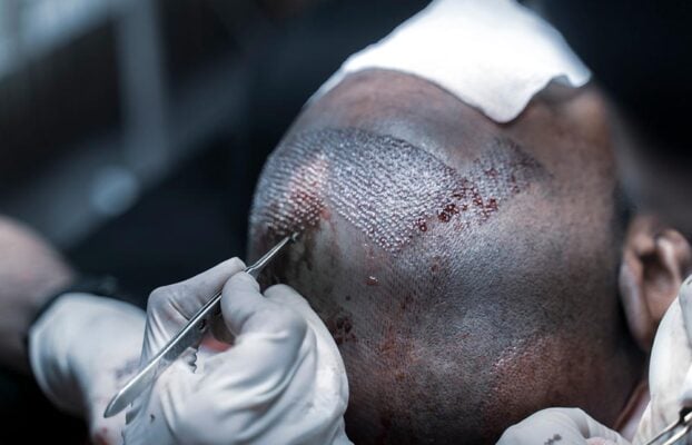 The Best Hair Transplant Center in Turkey