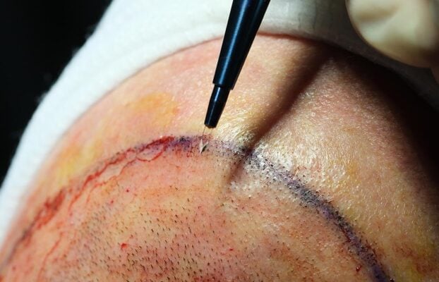 What is Laser-Assisted Hair Transplant?