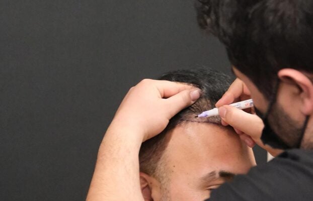 Which Season is Best for Hair Transplantation?