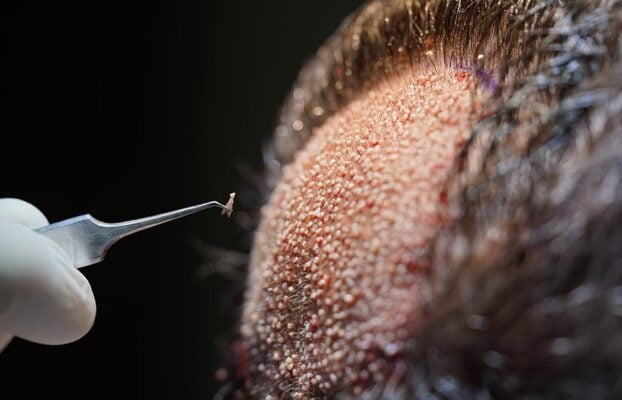 What is the Ideal Age for Hair Transplantation?