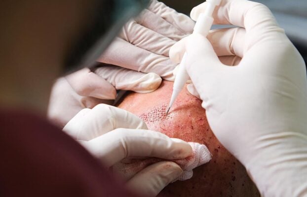 Why Are Hair Transplant Costs More Affordable in Turkey?
